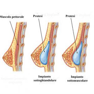 Mastoplastica Additiva Napoli